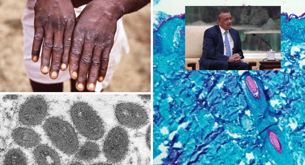 No momento, você está visualizando Breves: OMS declara Monkeypox emergência de saúde global